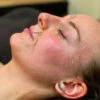 Curso De Acupuntura Facial Estética