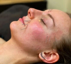 Curso De Acupuntura Facial Estética